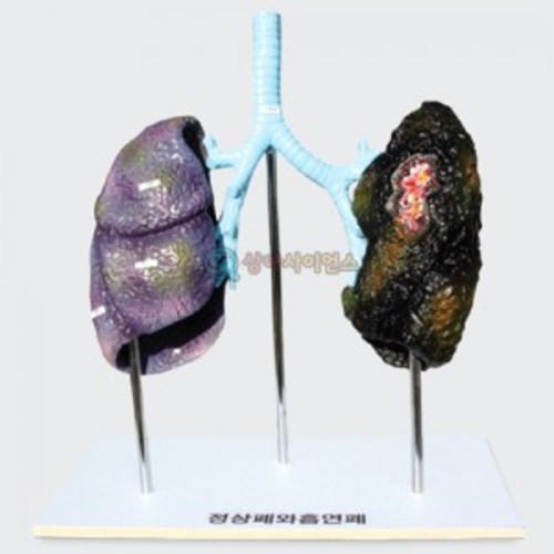 폐의 비교 (정상폐와 흡연폐)-칭찬나라큰나라